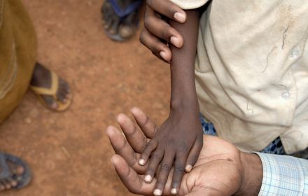A thin refugee child's hand lies in the palm of an adults hand - Somalia refugee camp